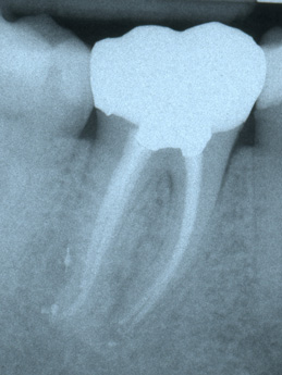 Bone regeneration after 18 months